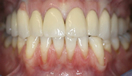 Composite Fillings After