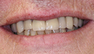 Smile Makeover with Dentures and Crowns After