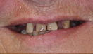 Smile Makeover with Dentures and Crowns Before