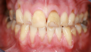 Composite Fillings Before